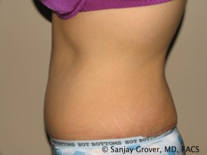 Tummy Tuck Before and After 78 | Sanjay Grover MD FACS