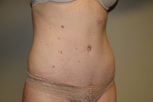 Tummy Tuck Before and After 79 | Sanjay Grover MD FACS