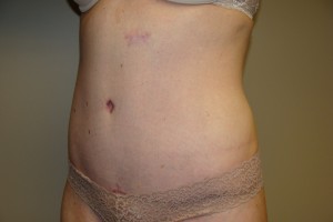 Tummy Tuck Before and After 79 | Sanjay Grover MD FACS