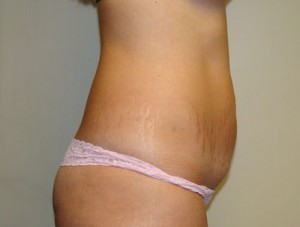 Tummy Tuck Before and After 84 | Sanjay Grover MD FACS