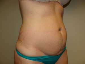 Tummy Tuck Before and After 85 | Sanjay Grover MD FACS