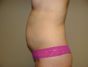 Tummy Tuck Before and After 90 | Sanjay Grover MD FACS