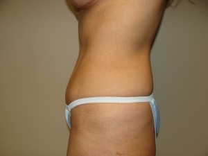 Tummy Tuck Before and After 91 | Sanjay Grover MD FACS