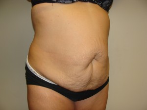 Tummy Tuck Before and After 92 | Sanjay Grover MD FACS