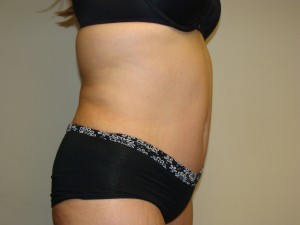 Tummy Tuck Before and After 92 | Sanjay Grover MD FACS