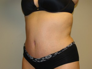 Tummy Tuck Before and After 92 | Sanjay Grover MD FACS