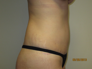 Tummy Tuck Before and After 93 | Sanjay Grover MD FACS