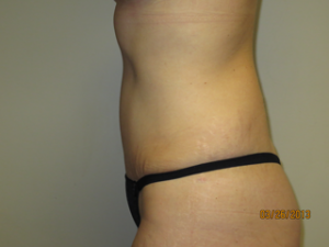 Tummy Tuck Before and After 93 | Sanjay Grover MD FACS