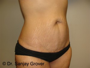 Tummy Tuck Before and After 94 | Sanjay Grover MD FACS