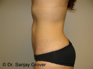 Tummy Tuck Before and After 94 | Sanjay Grover MD FACS