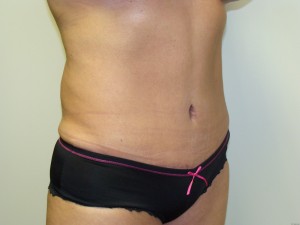 Tummy Tuck Before and After 95 | Sanjay Grover MD FACS