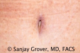 Tummy Tuck Before and After 96 | Sanjay Grover MD FACS