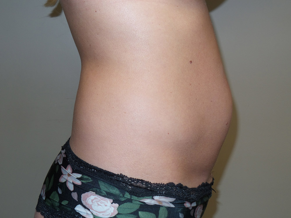 Tummy Tuck Before and After 97 | Sanjay Grover MD FACS