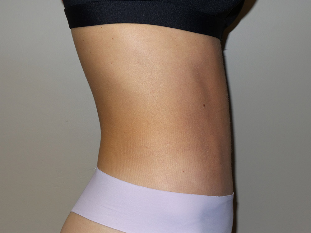 Tummy Tuck Before and After 97 | Sanjay Grover MD FACS