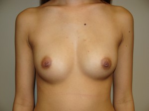 Breast Augmentation Before and After 72 | Sanjay Grover MD FACS