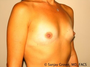 Breast Augmentation Before and After 103 | Sanjay Grover MD FACS