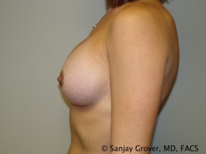 Breast Augmentation Before and After 103 | Sanjay Grover MD FACS