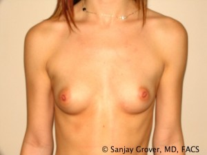 Breast Augmentation Before and After 243 | Sanjay Grover MD FACS
