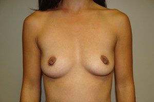 Breast Augmentation Before and After 269 | Sanjay Grover MD FACS