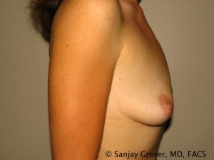 Breast Augmentation Before and After 112 | Sanjay Grover MD FACS