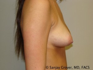 Breast Augmentation Before and After 113 | Sanjay Grover MD FACS