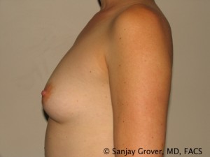 Breast Augmentation Before and After 119 | Sanjay Grover MD FACS