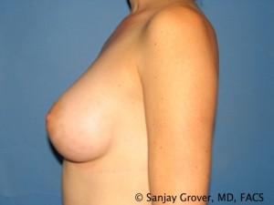 Breast Augmentation Before and After 119 | Sanjay Grover MD FACS