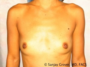 Breast Augmentation Before and After 244 | Sanjay Grover MD FACS
