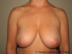 Breast Augmentation Before and After 51 | Sanjay Grover MD FACS