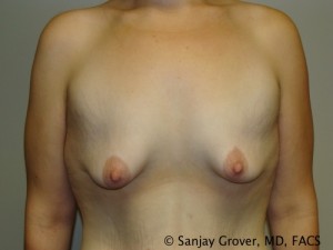 Breast Augmentation Before and After 43 | Sanjay Grover MD FACS