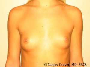 Breast Augmentation Before and After 06 | Sanjay Grover MD FACS