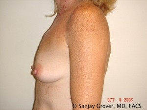 Breast Augmentation Before and After 125 | Sanjay Grover MD FACS