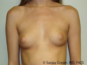 Breast Augmentation Before and After 91 | Sanjay Grover MD FACS