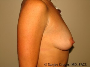 Breast Augmentation Before and After 133 | Sanjay Grover MD FACS