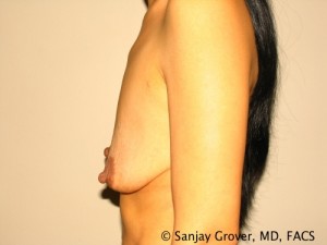 Breast Augmentation Before and After 133 | Sanjay Grover MD FACS