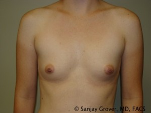 Breast Augmentation Before and After 300 | Sanjay Grover MD FACS