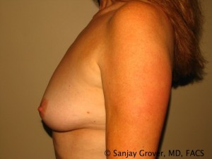 Breast Augmentation Before and After 140 | Sanjay Grover MD FACS