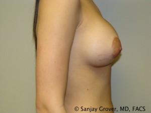 Breast Augmentation Before and After 141 | Sanjay Grover MD FACS