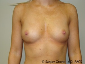 Breast Augmentation Before and After 32 | Sanjay Grover MD FACS