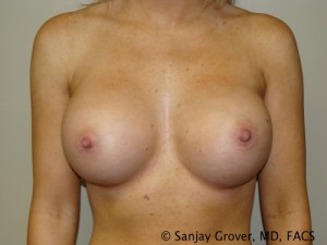 Breast Augmentation Before and After | Sanjay Grover MD FACS