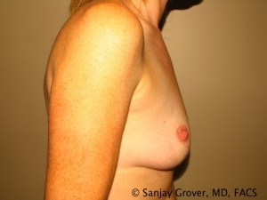 Breast Augmentation Before and After 142 | Sanjay Grover MD FACS