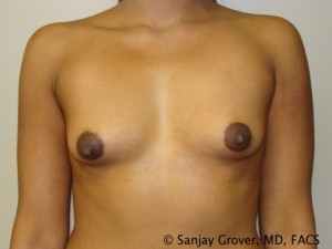 Breast Augmentation Before and After 15 | Sanjay Grover MD FACS
