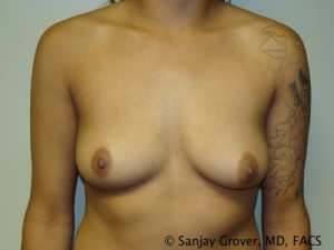 Breast Augmentation Before and After 76 | Sanjay Grover MD FACS