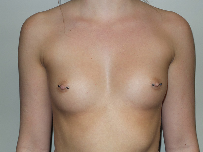 Breast Augmentation Before and After 34 | Sanjay Grover MD FACS