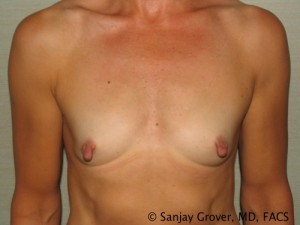 Breast Augmentation Before and After 01 | Sanjay Grover MD FACS