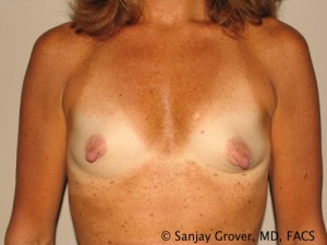 Breast Augmentation Before and After 33 | Sanjay Grover MD FACS