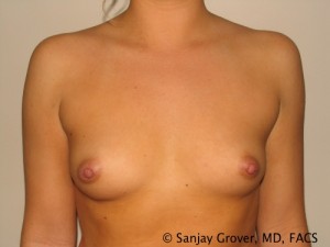 Breast Augmentation Before and After 19 | Sanjay Grover MD FACS