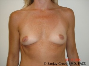 Breast Augmentation Before and After 104 | Sanjay Grover MD FACS