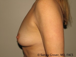 Breast Augmentation Before and After 157 | Sanjay Grover MD FACS