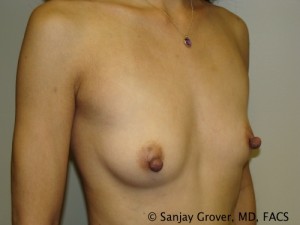 Breast Augmentation Before and After 159 | Sanjay Grover MD FACS